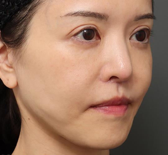 50代女性の人中短縮（リップリフト） After 症例写真