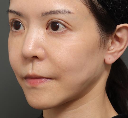 50代女性の人中短縮（リップリフト） Before 症例写真