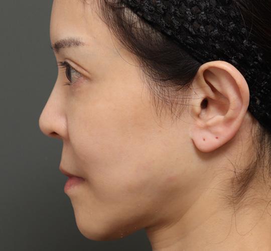 50代女性の人中短縮（リップリフト） Before 症例写真