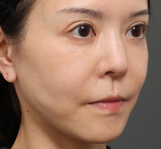 50代女性の人中短縮（リップリフト） Before 症例写真
