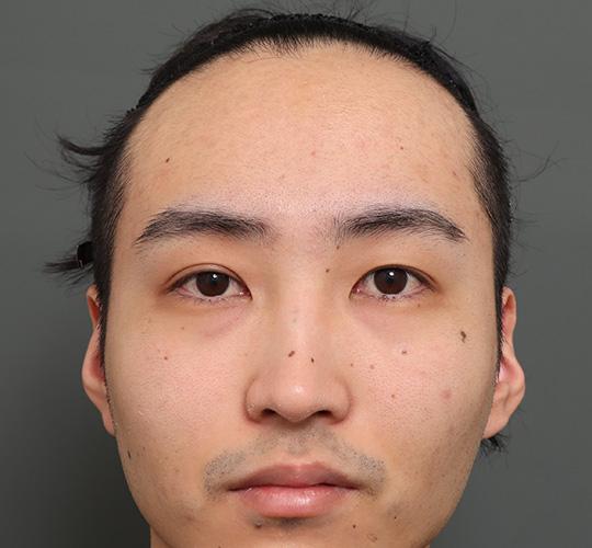 20代男性のエラ・アゴ・小顔 Before 症例写真