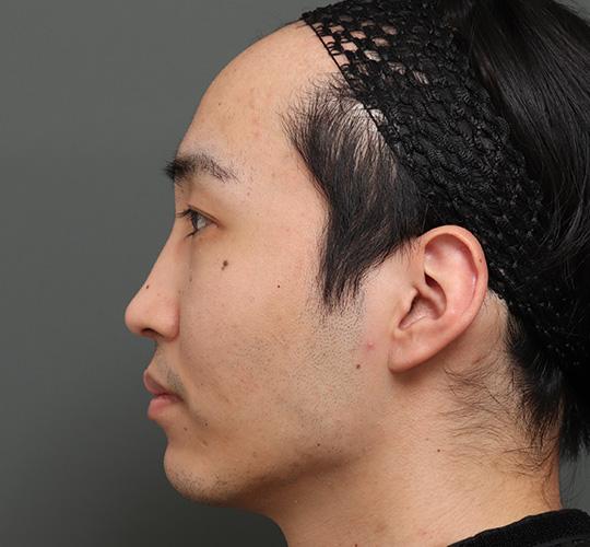 20代男性の額縮小 Before 症例写真