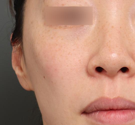 40代女性のジュベルックスキンボトックス After 症例写真