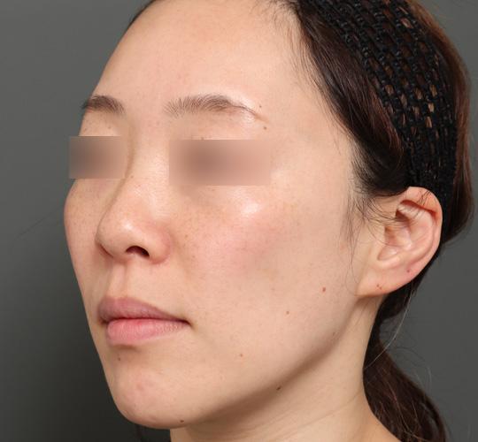 40代女性の美肌治療 After 症例写真