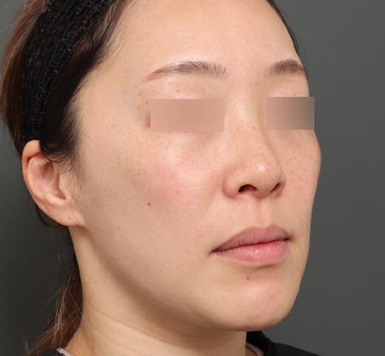 40代女性のジュベルックスキンボトックス After 症例写真