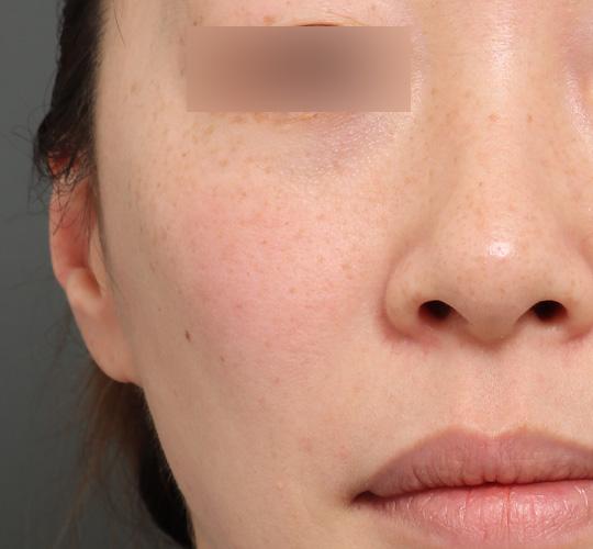 40代女性のジュベルックスキンボトックス Before 症例写真