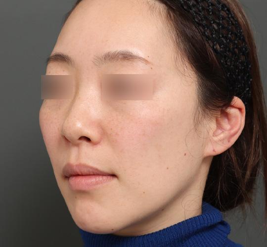 40代女性の美肌治療 Before 症例写真