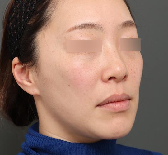 40代女性のジュベルックスキンボトックス Before 症例写真