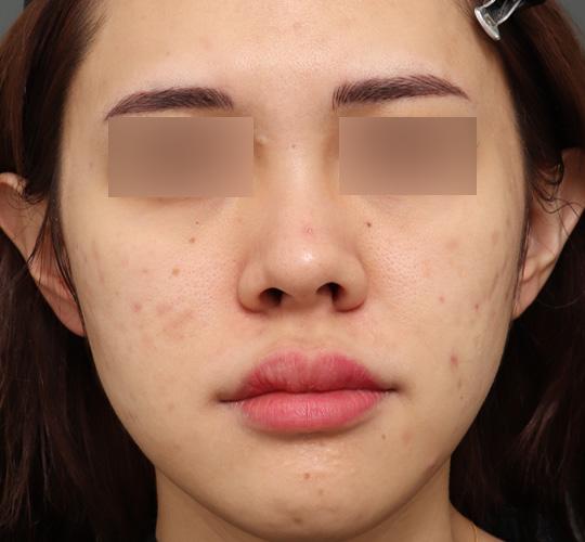 20代女性のクラリティフォトフェイシャルプラス After 症例写真