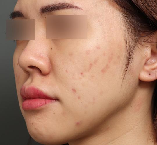 20代女性のクラリティフォトフェイシャルプラス After 症例写真