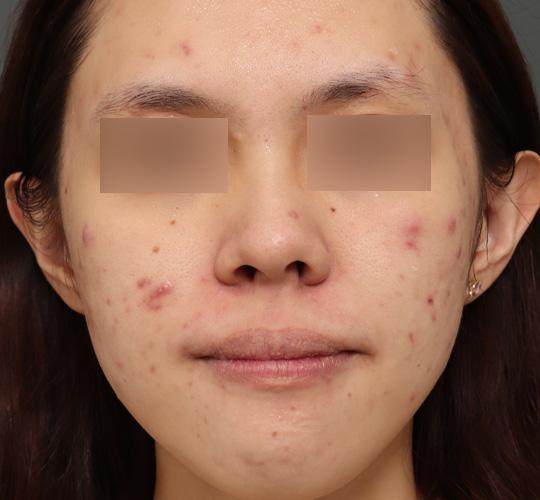 20代女性のクラリティフォトフェイシャルプラス Before 症例写真