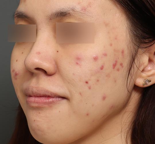 20代女性のクラリティフォトフェイシャルプラス Before 症例写真