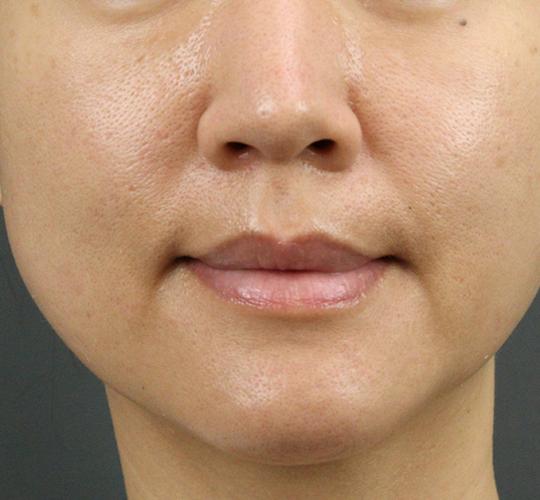40代女性のリジュランスキンボトックス After 症例写真