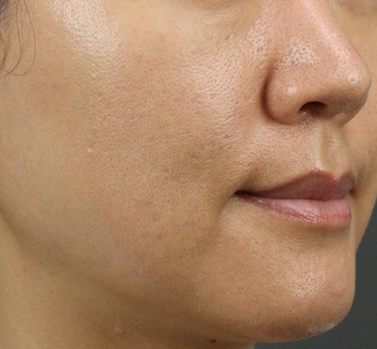 40代女性のリジュランスキンボトックス After 症例写真