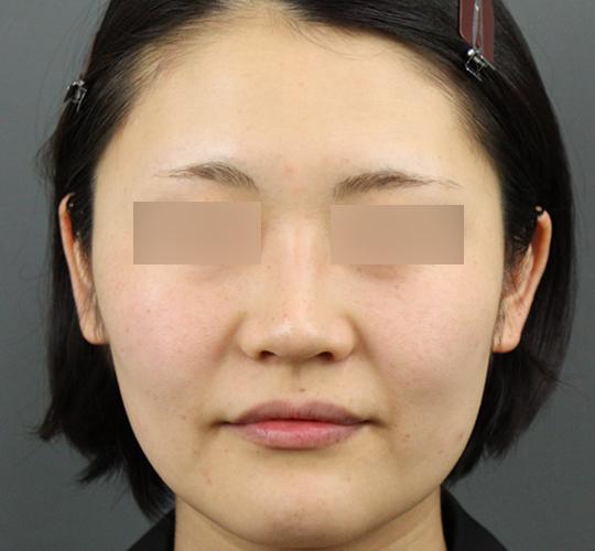30代女性のシミ・そばかす After 症例写真