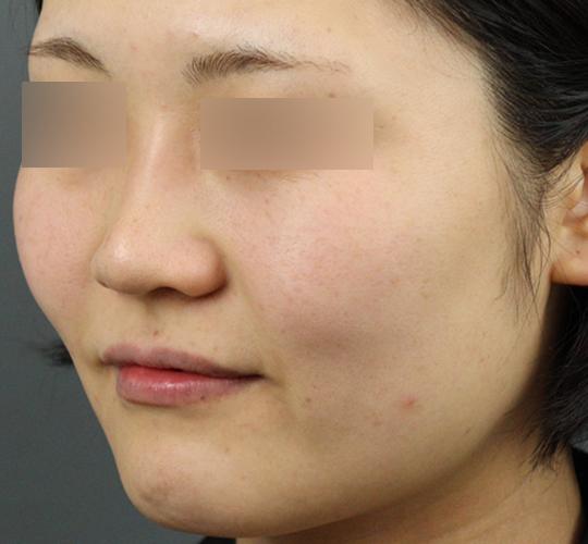 30代女性のクラリティフォトフェイシャルプラス After 症例写真