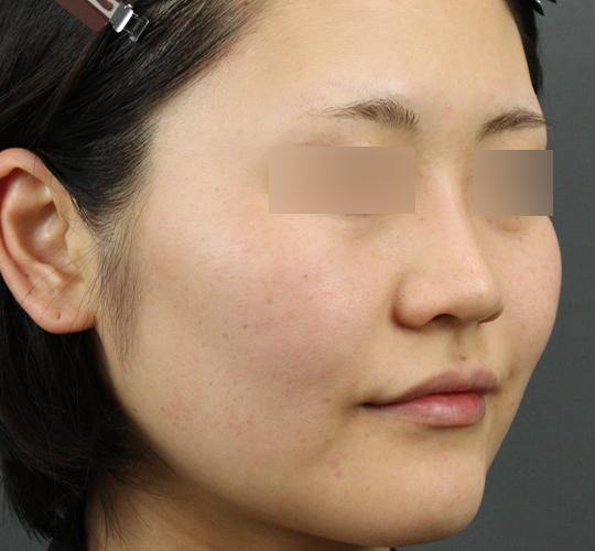 30代女性のクラリティフォトフェイシャルプラス After 症例写真