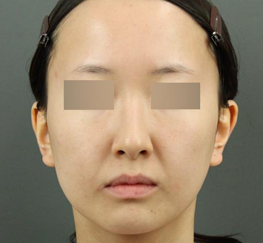 20代女性のシミ・そばかす After 症例写真