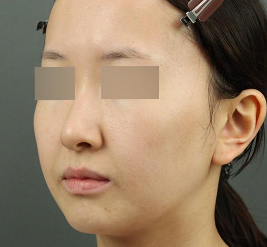 20代女性のクラリティフォトフェイシャルプラス After 症例写真