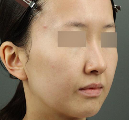 20代女性のクラリティフォトフェイシャルプラス After 症例写真