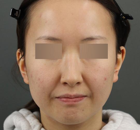 20代女性のシミ・そばかす Before 症例写真