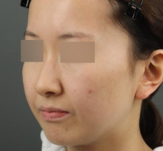 20代女性のクラリティフォトフェイシャルプラス Before 症例写真