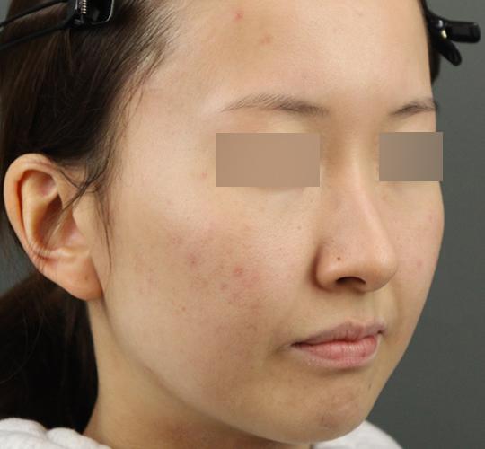 20代女性のクラリティフォトフェイシャルプラス Before 症例写真