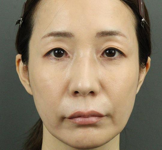 40代女性のヒアルロン酸注射 After 症例写真