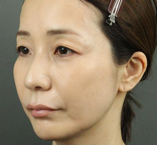 40代女性のヒアルロン酸注射  After 症例写真