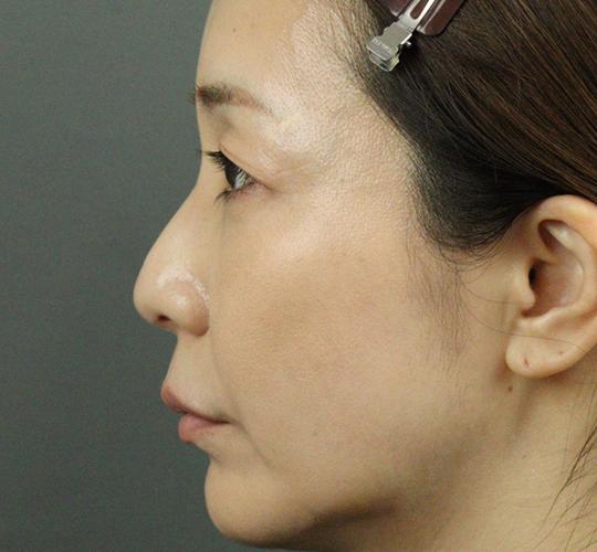 40代女性のヒアルロン酸注射  After 症例写真