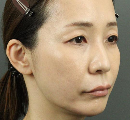 40代女性のヒアルロン酸注射  After 症例写真