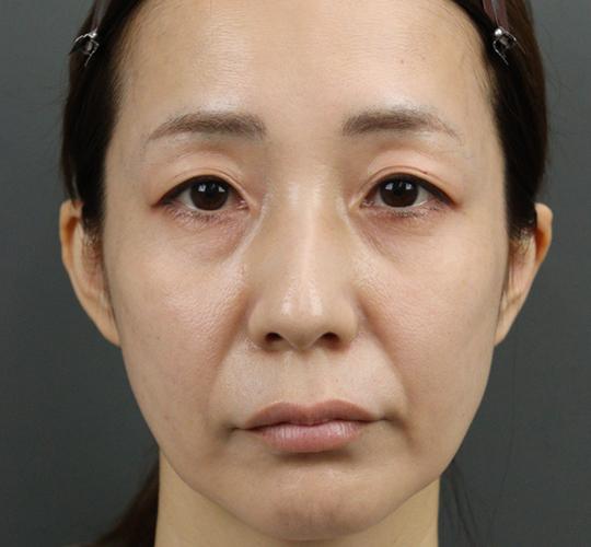 40代女性のヒアルロン酸注射 Before 症例写真