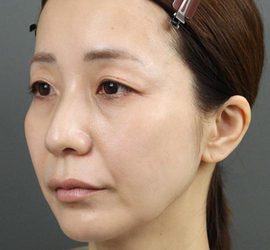 40代女性のヒアルロン酸注射  Before 症例写真