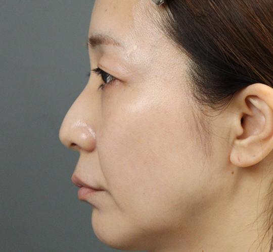 40代女性のヒアルロン酸注射  Before 症例写真