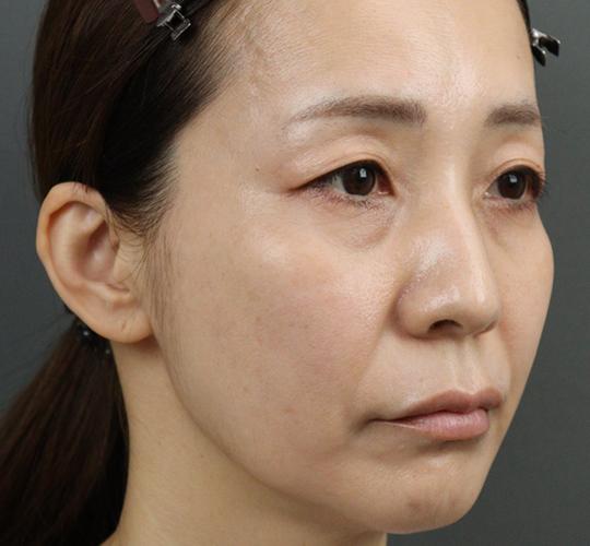 40代女性のヒアルロン酸注射  Before 症例写真