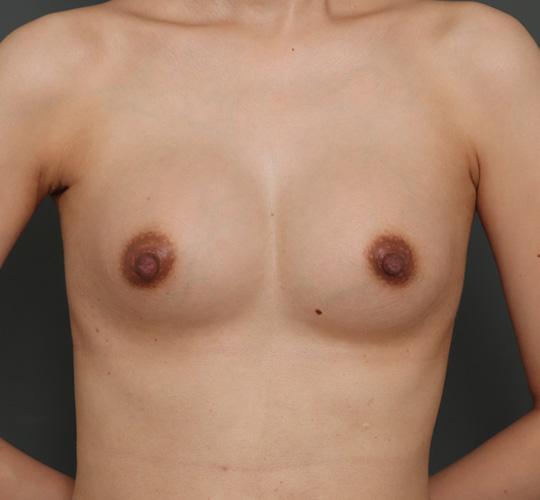 30代女性のハイブリッド豊胸 After 症例写真