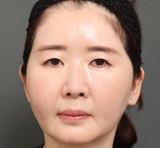 50代女性のVラインサクションリフト After 症例写真