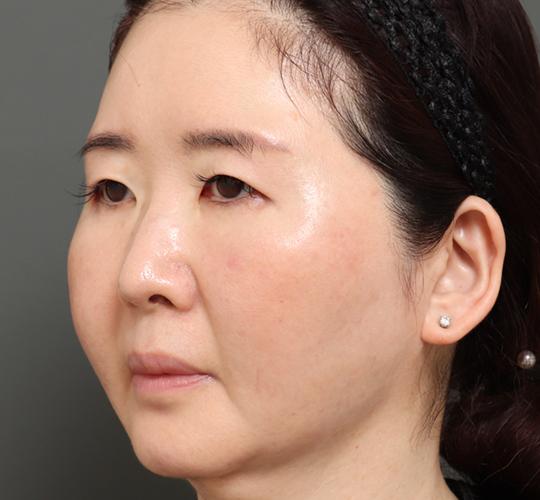 50代女性のVラインサクションリフト After 症例写真