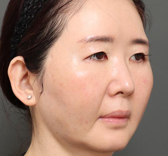 50代女性のVラインサクションリフト After 症例写真