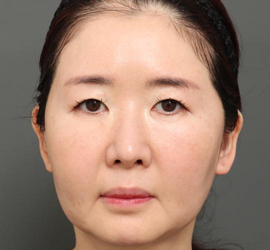 50代女性のVラインサクションリフト Before 症例写真