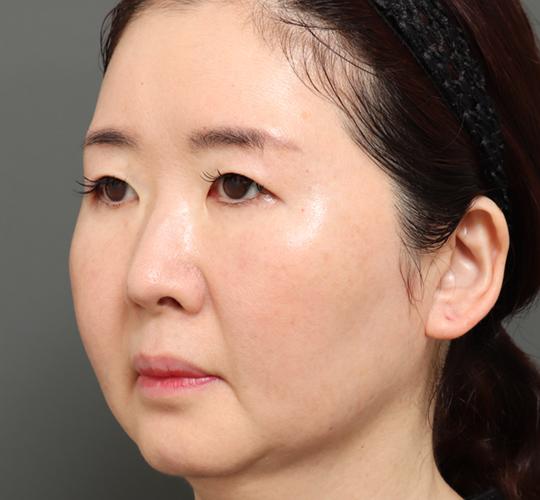 50代女性のVラインサクションリフト Before 症例写真