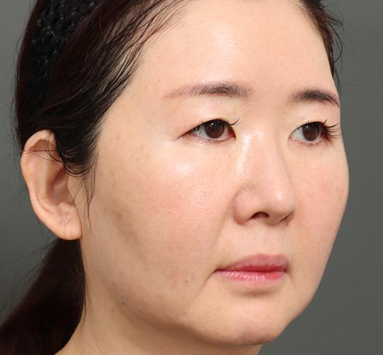 50代女性のVラインサクションリフト Before 症例写真