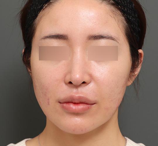 30代女性のジュべルック After 症例写真