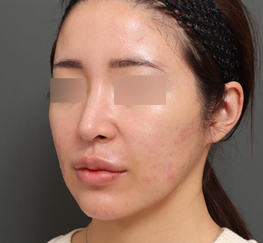 30代女性のジュべルック After 症例写真