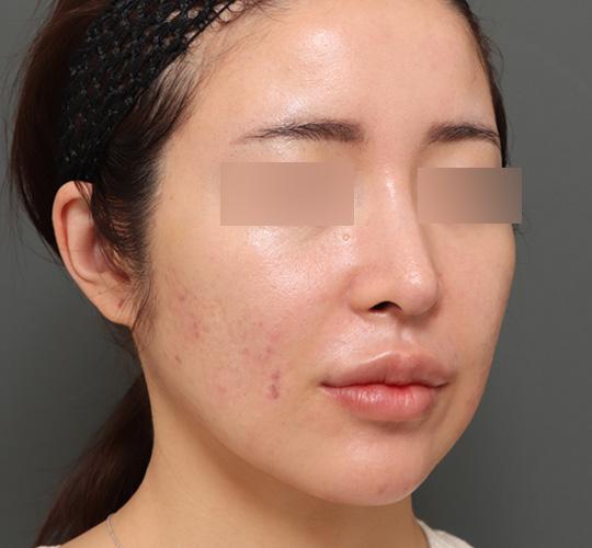 30代女性のシミ・そばかす After 症例写真