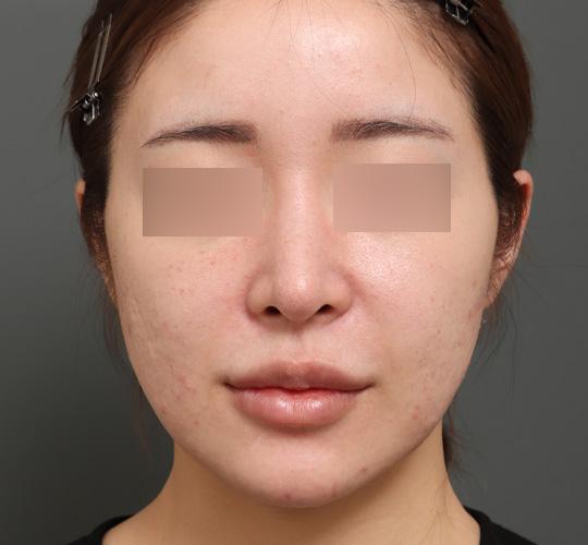 30代女性のジュべルック Before 症例写真