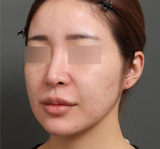 30代女性のジュべルック Before 症例写真