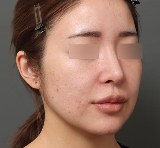 30代女性のシミ・そばかす Before 症例写真
