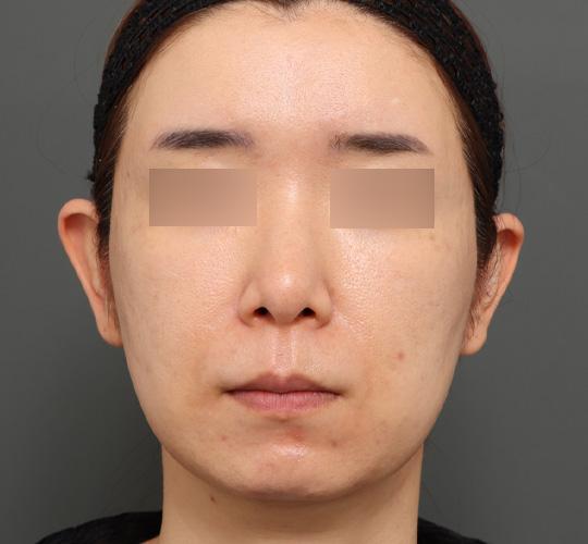 40代女性のボルニューマー After 症例写真