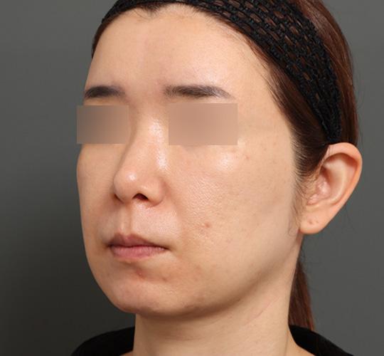 40代女性のボルニューマー After 症例写真